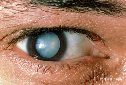 糖尿病并发症:眼疾和失明